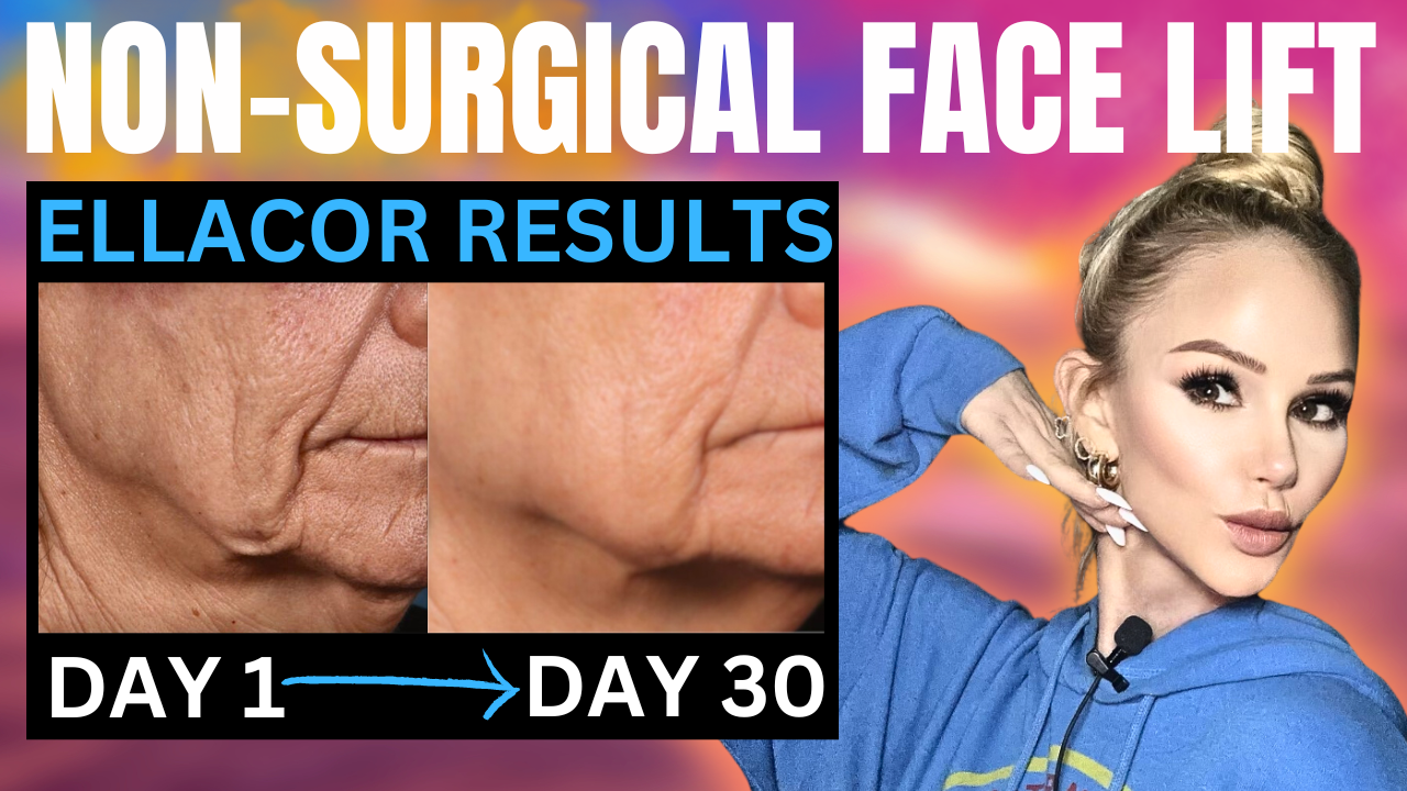 The “Scarless” Non Surgical Face Lift: Ellacor Follow up