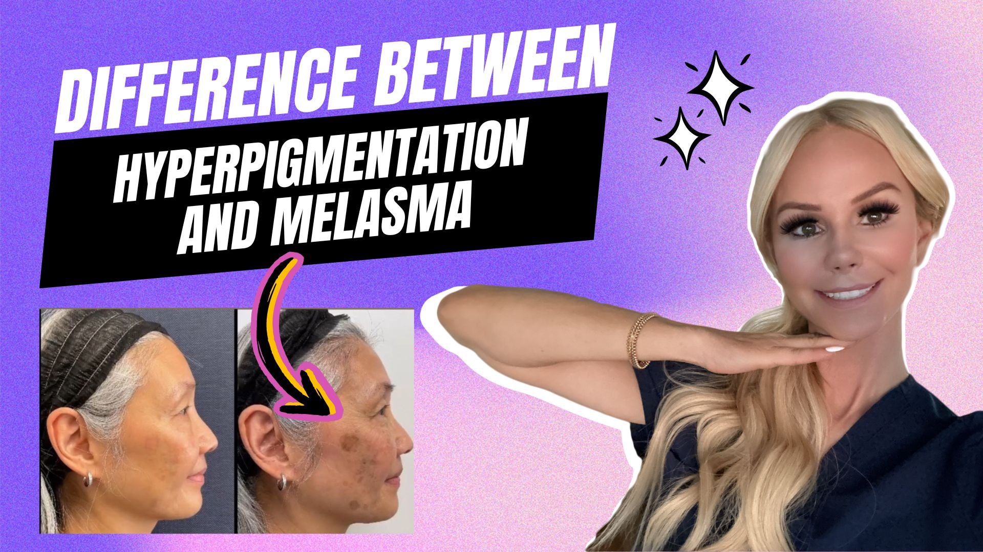 Understanding Hyperpigmentation and Melasma