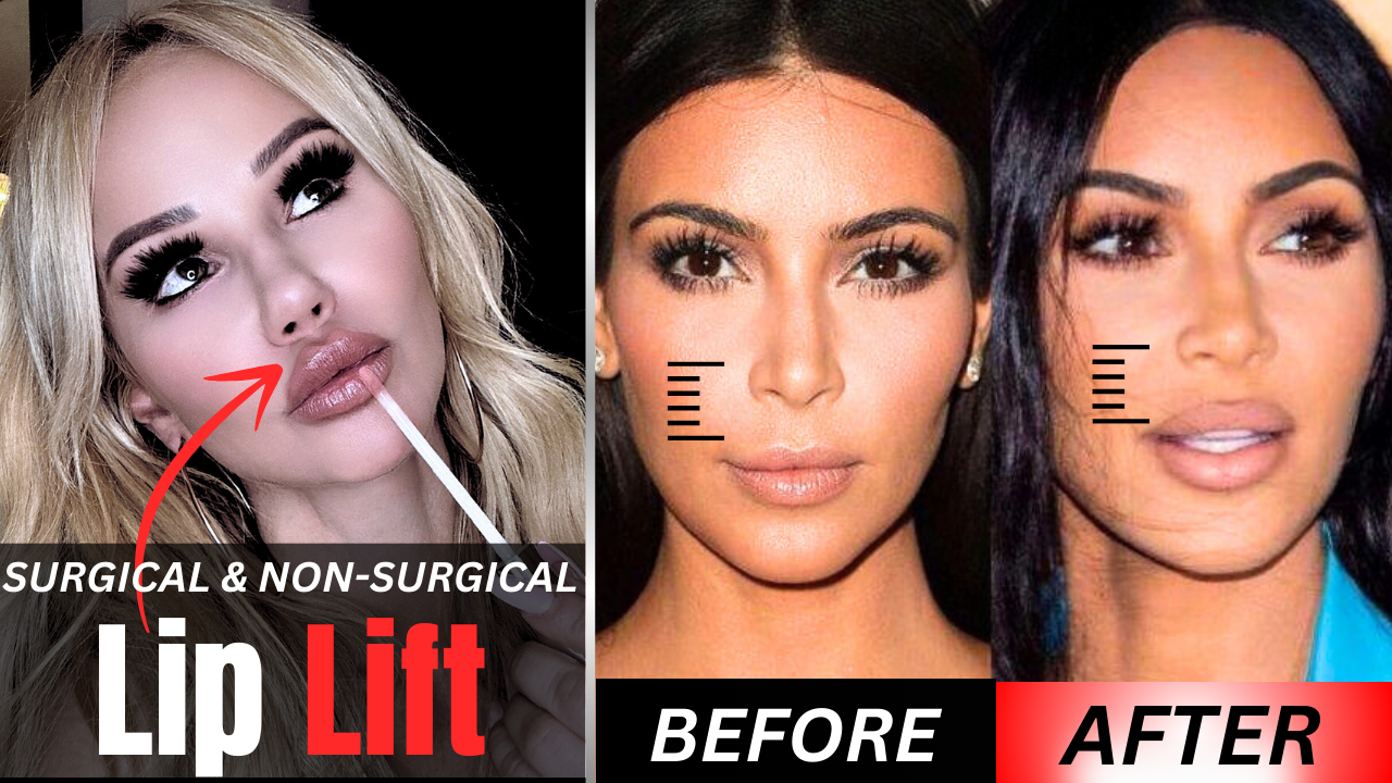 LIP LIFTING: Surgical and Non Surgical options