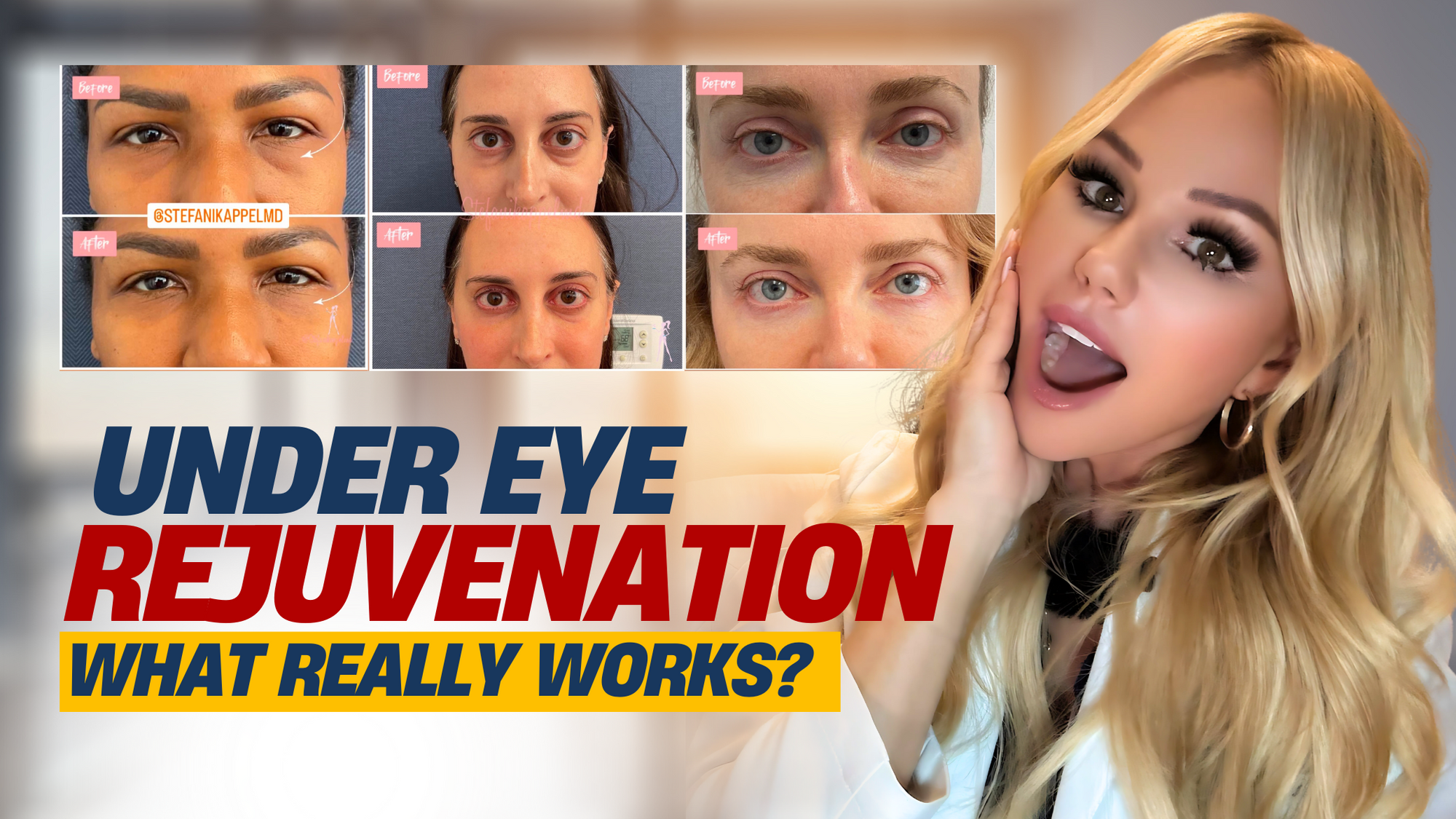 Most Requested Area: Under Eye Rejuvenation